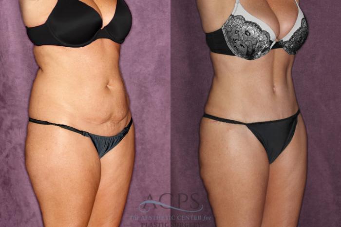 Before & After Tummy Tuck Case 48 Oblique Right View: View in Houston, TX