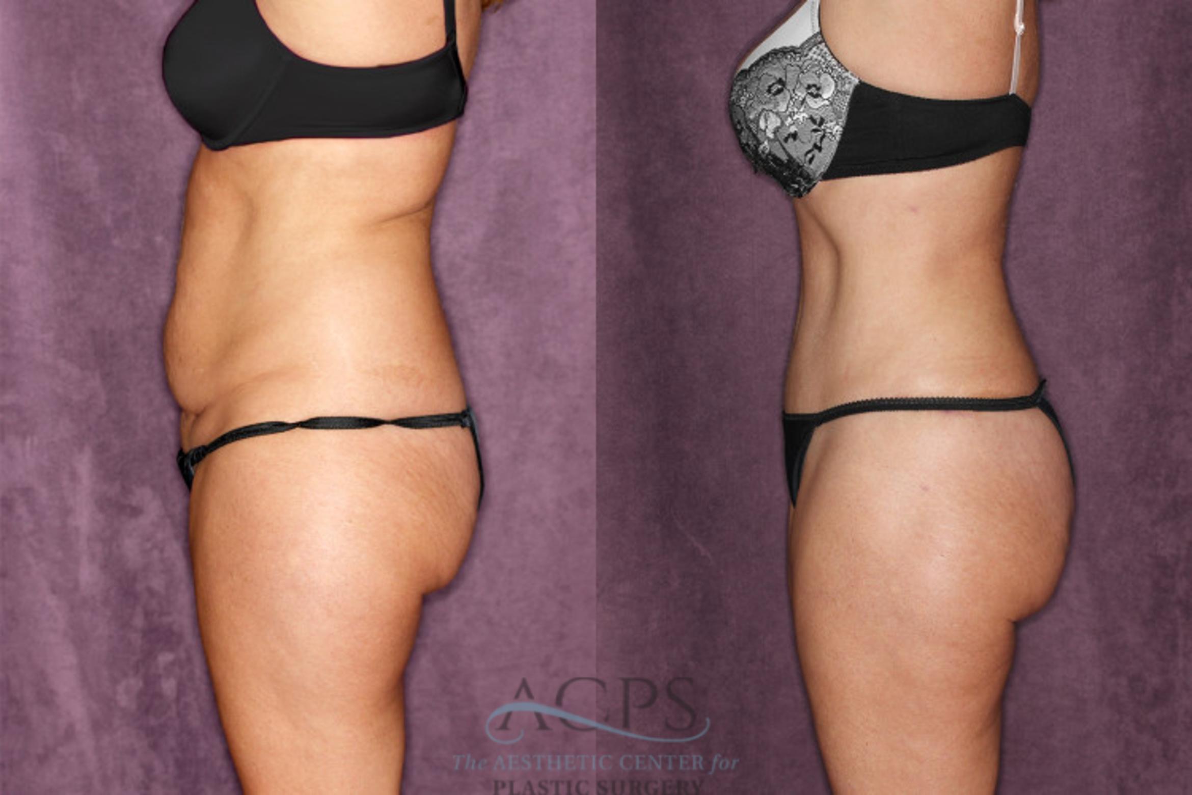 Before & After Tummy Tuck Case 48 Side Left View: View in Houston, TX