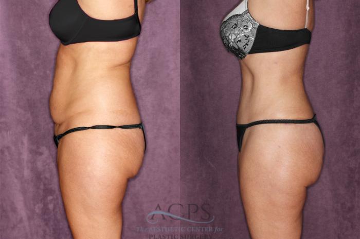 Before & After Tummy Tuck Case 48 Side Left View: View in Houston, TX