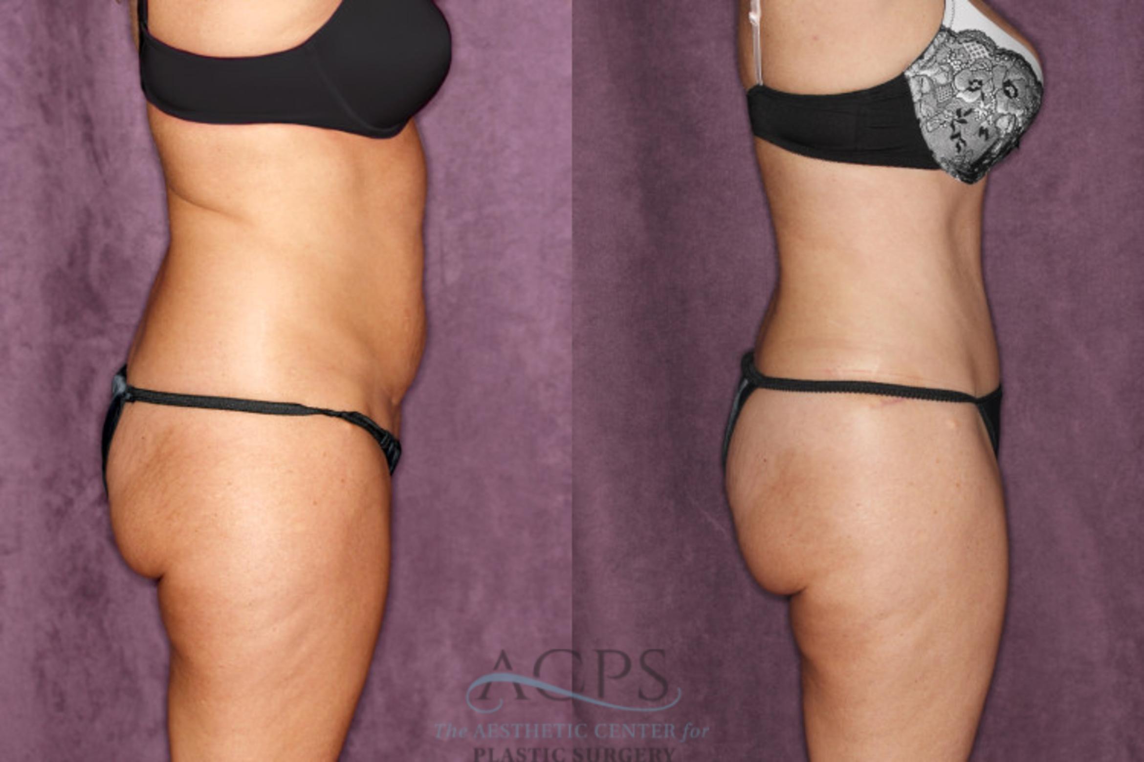 Before & After Tummy Tuck Case 48 Side Right View: View in Houston, TX