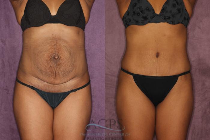 Before & After Tummy Tuck Case 49 Front View: View in Houston, TX