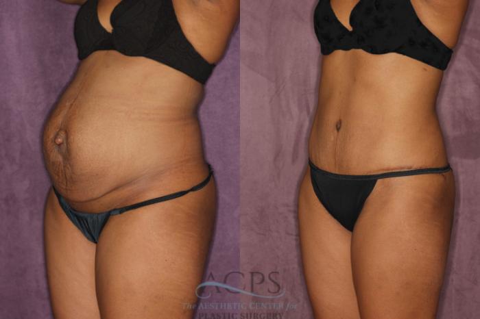 Before & After Tummy Tuck Case 49 Oblique Left View: View in Houston, TX