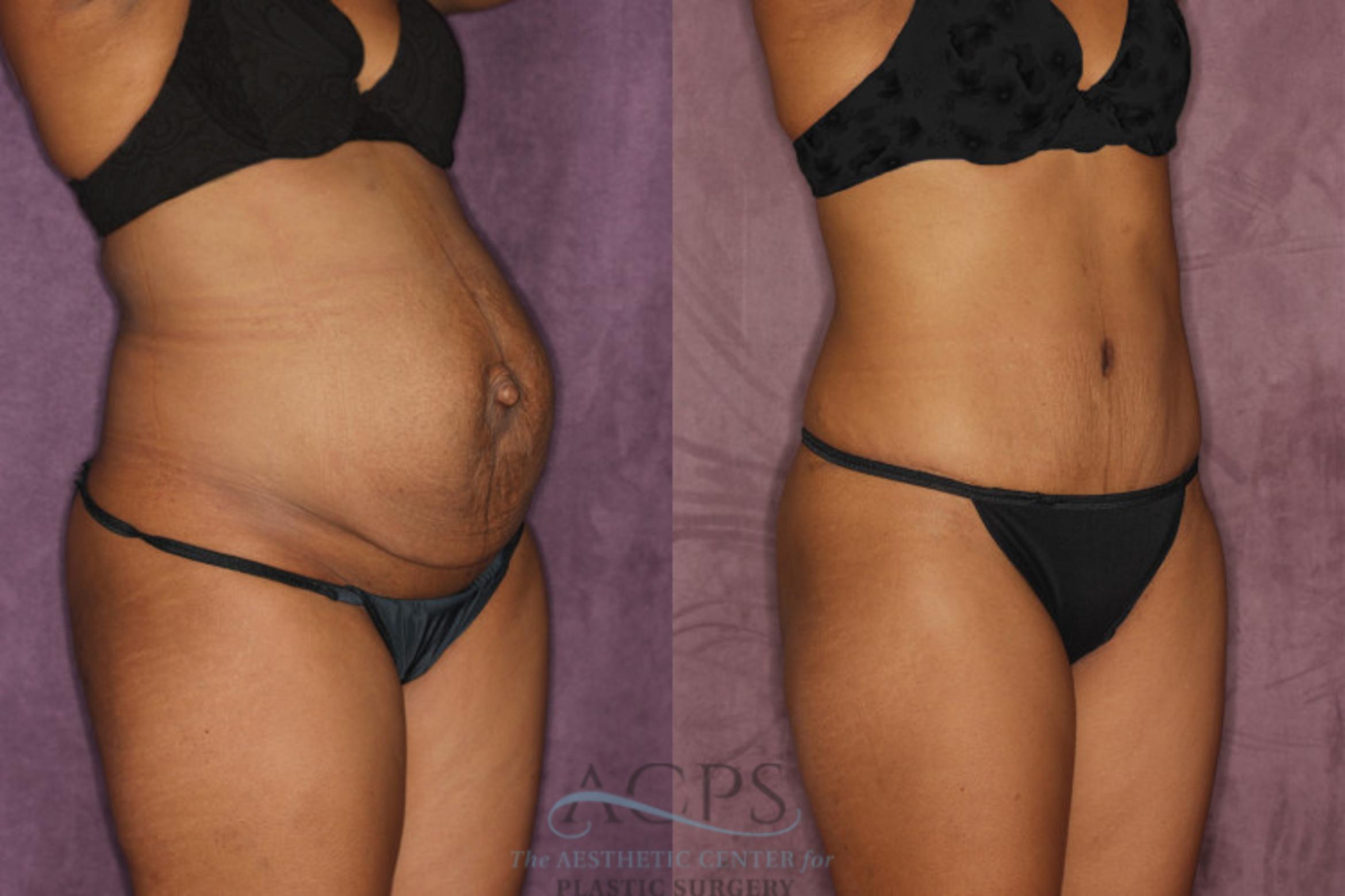 Before & After Tummy Tuck Case 49 Oblique Right View: View in Houston, TX
