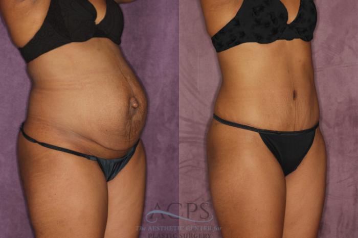 Before & After Tummy Tuck Case 49 Oblique Right View: View in Houston, TX