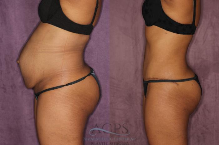 Before & After Tummy Tuck Case 49 Side Left View: View in Houston, TX