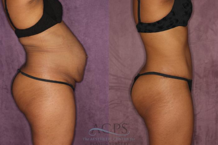Before & After Tummy Tuck Case 49 Side Right View: View in Houston, TX