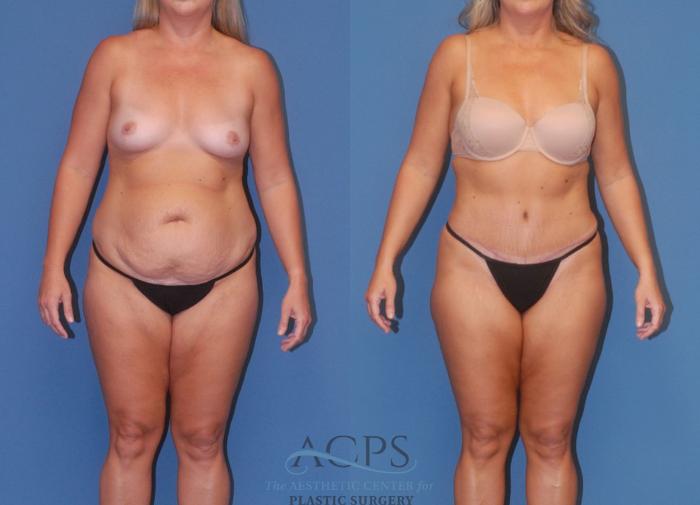 Before & After Tummy Tuck Case 5 Front View: View in Houston, TX