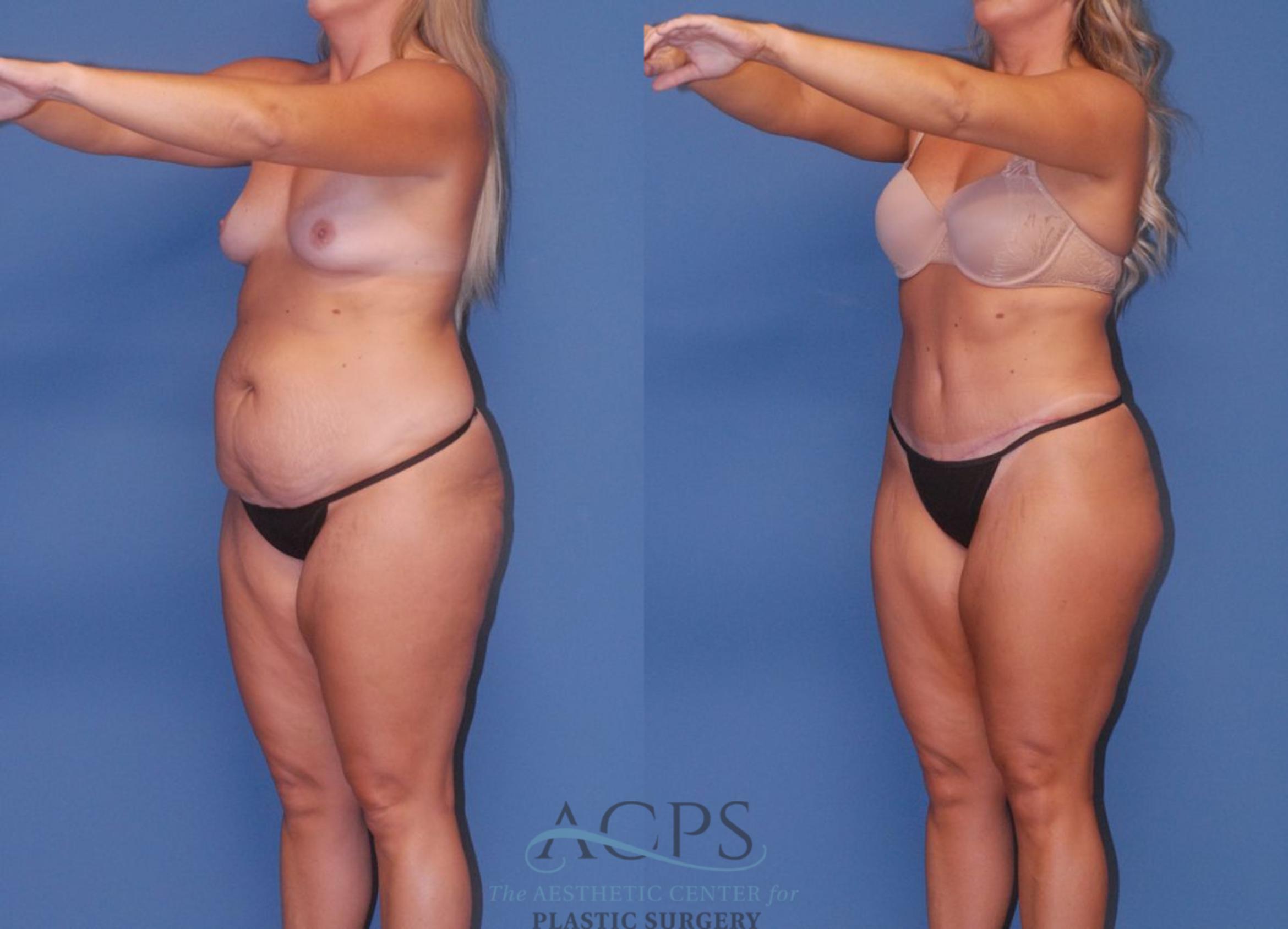 Before & After Tummy Tuck Case 5 Left Oblique View: View in Houston, TX
