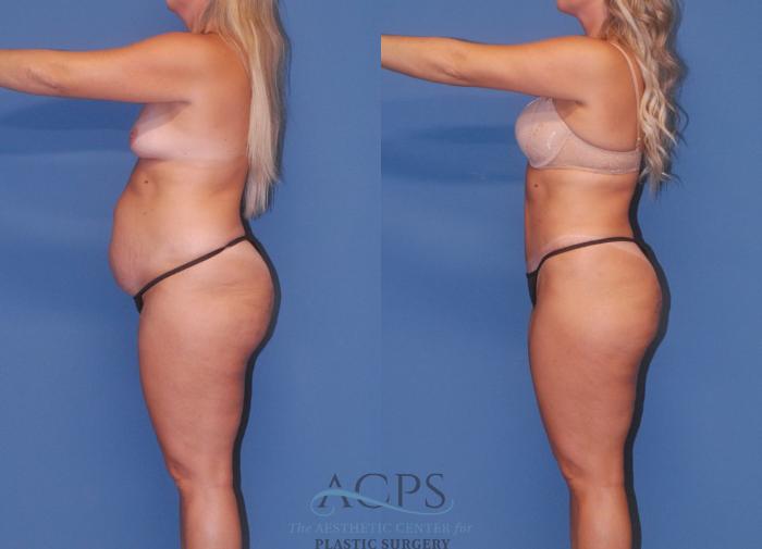 Before & After Tummy Tuck Case 5 Left Side View: View in Houston, TX