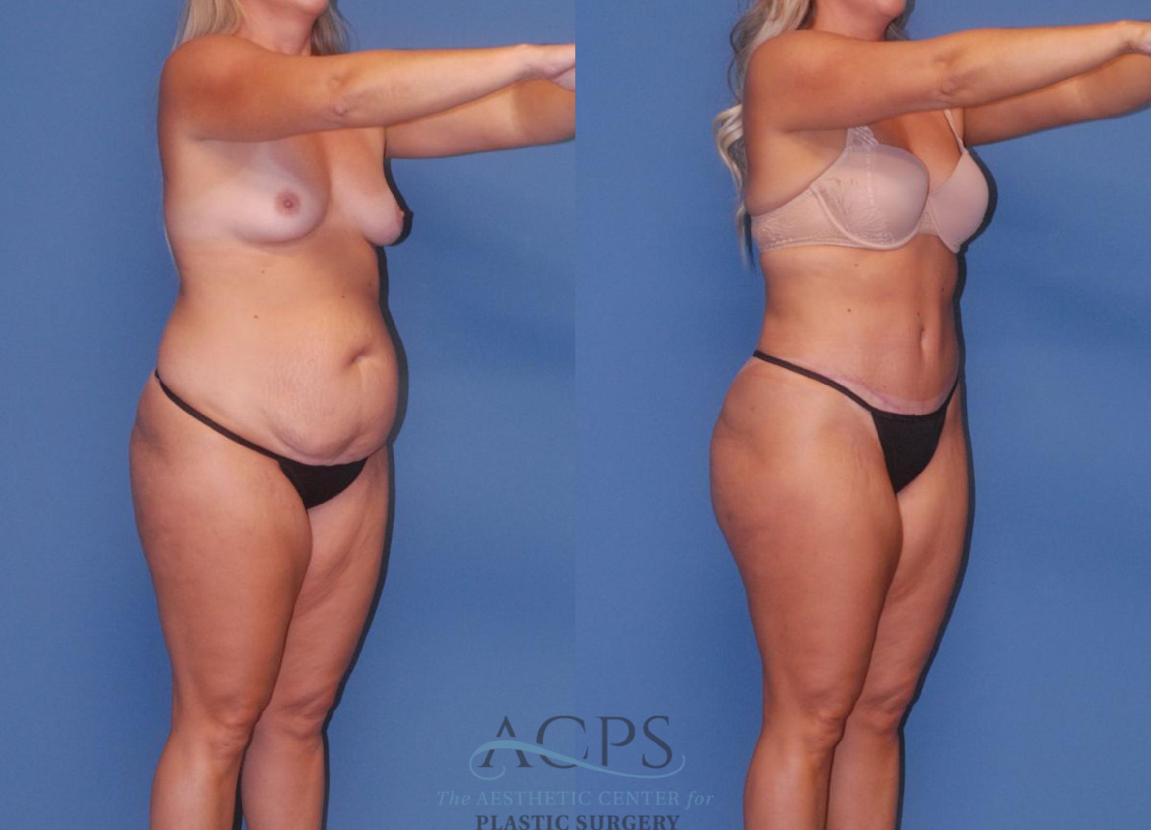 Before & After Tummy Tuck Case 5 Oblique View: View in Houston, TX