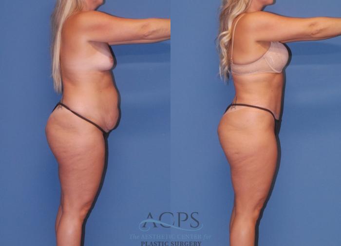 Before & After Tummy Tuck Case 5 Right Side View: View in Houston, TX