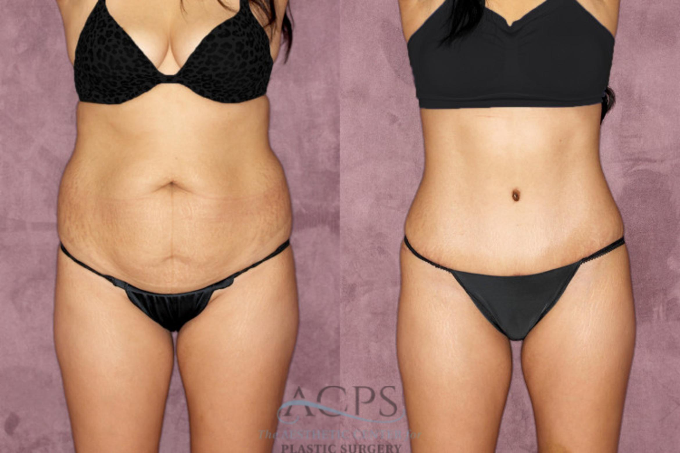 Before & After Tummy Tuck Case 50 Front View: View in Houston, TX