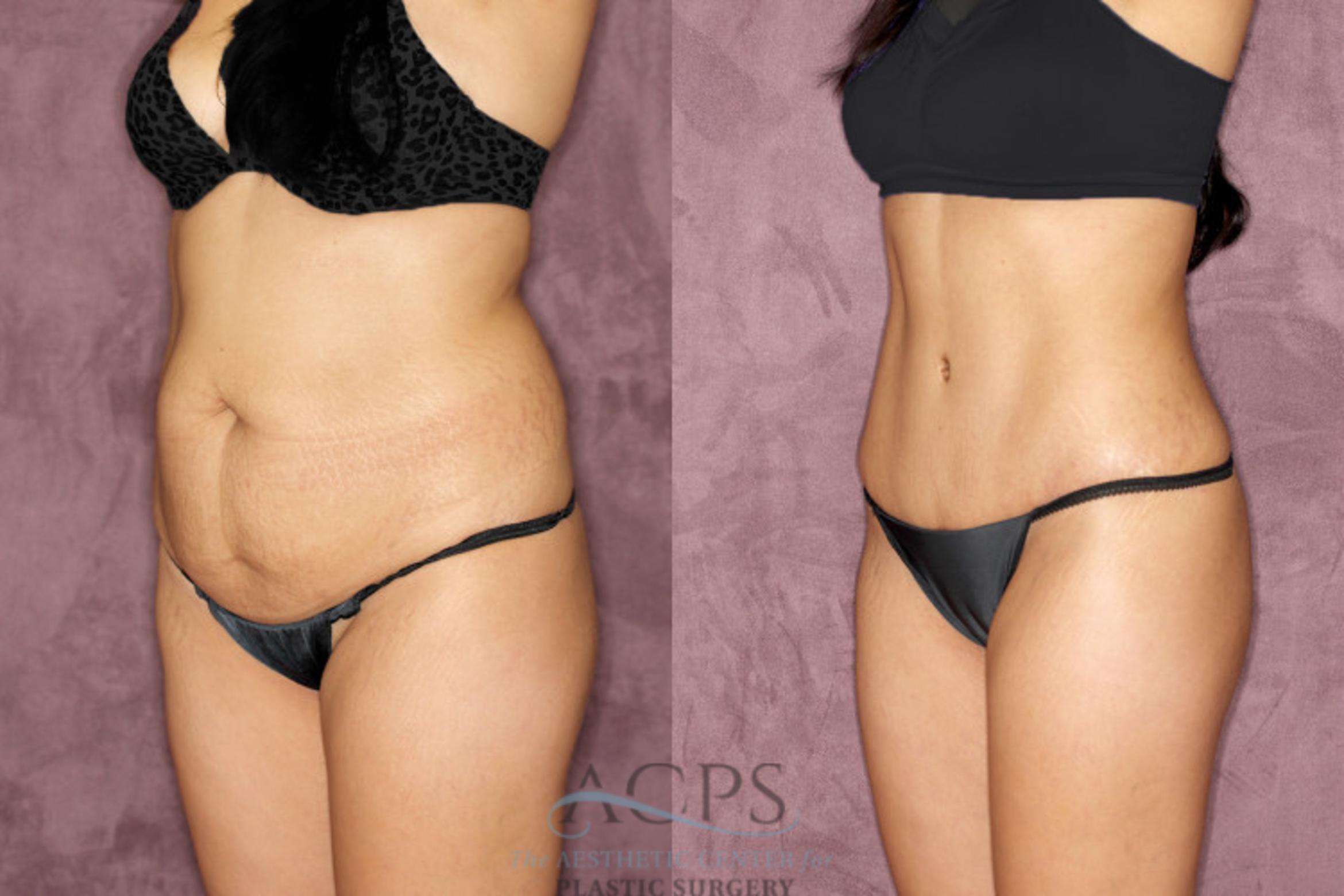 Before & After Tummy Tuck Case 50 Oblique Left View: View in Houston, TX