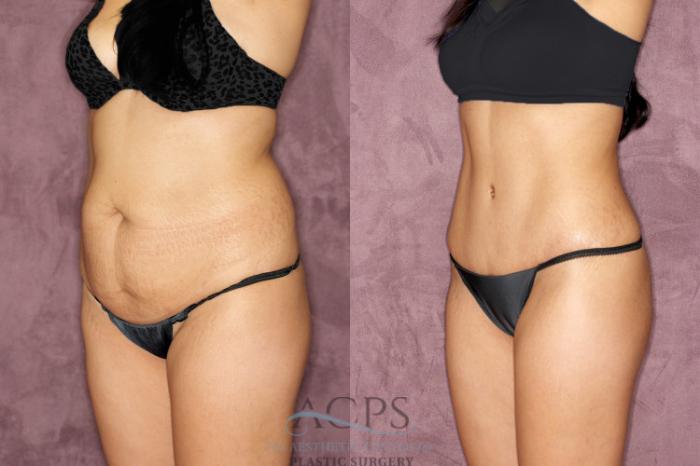 Before & After Tummy Tuck Case 50 Oblique Left View: View in Houston, TX