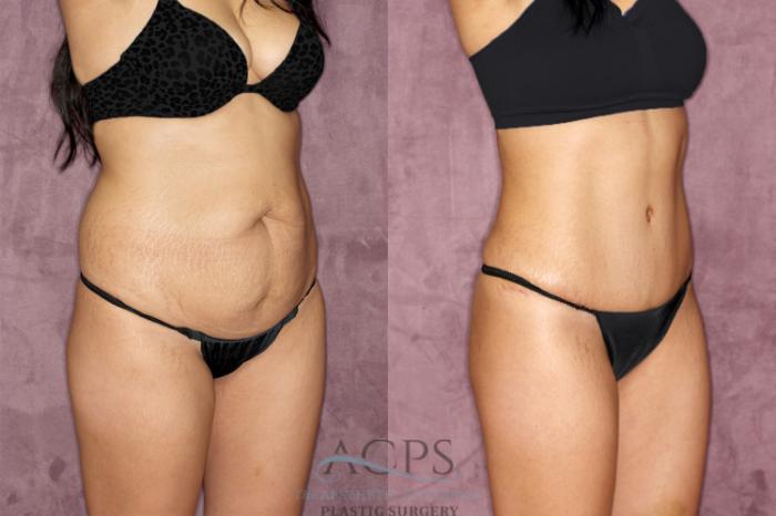 Before & After Tummy Tuck Case 50 Oblique Right View: View in Houston, TX