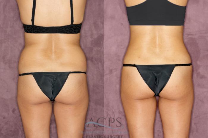 Before & After Tummy Tuck Case 50 Rear View: View in Houston, TX
