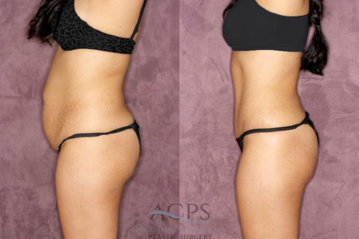Before & After Tummy Tuck Case 50 Side Left View: View in Houston, TX