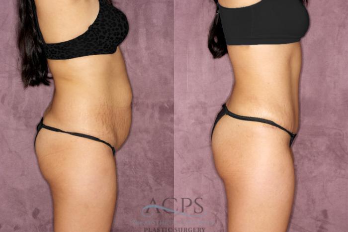 Before & After Tummy Tuck Case 50 Side Right View: View in Houston, TX