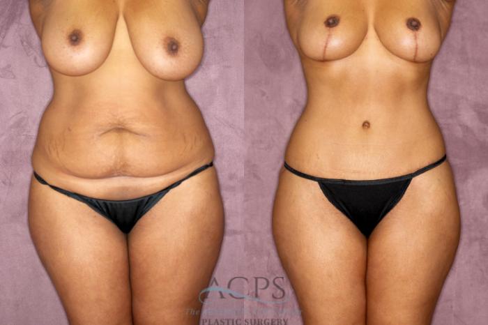 Before & After Tummy Tuck Case 51 Front View: View in Houston, TX