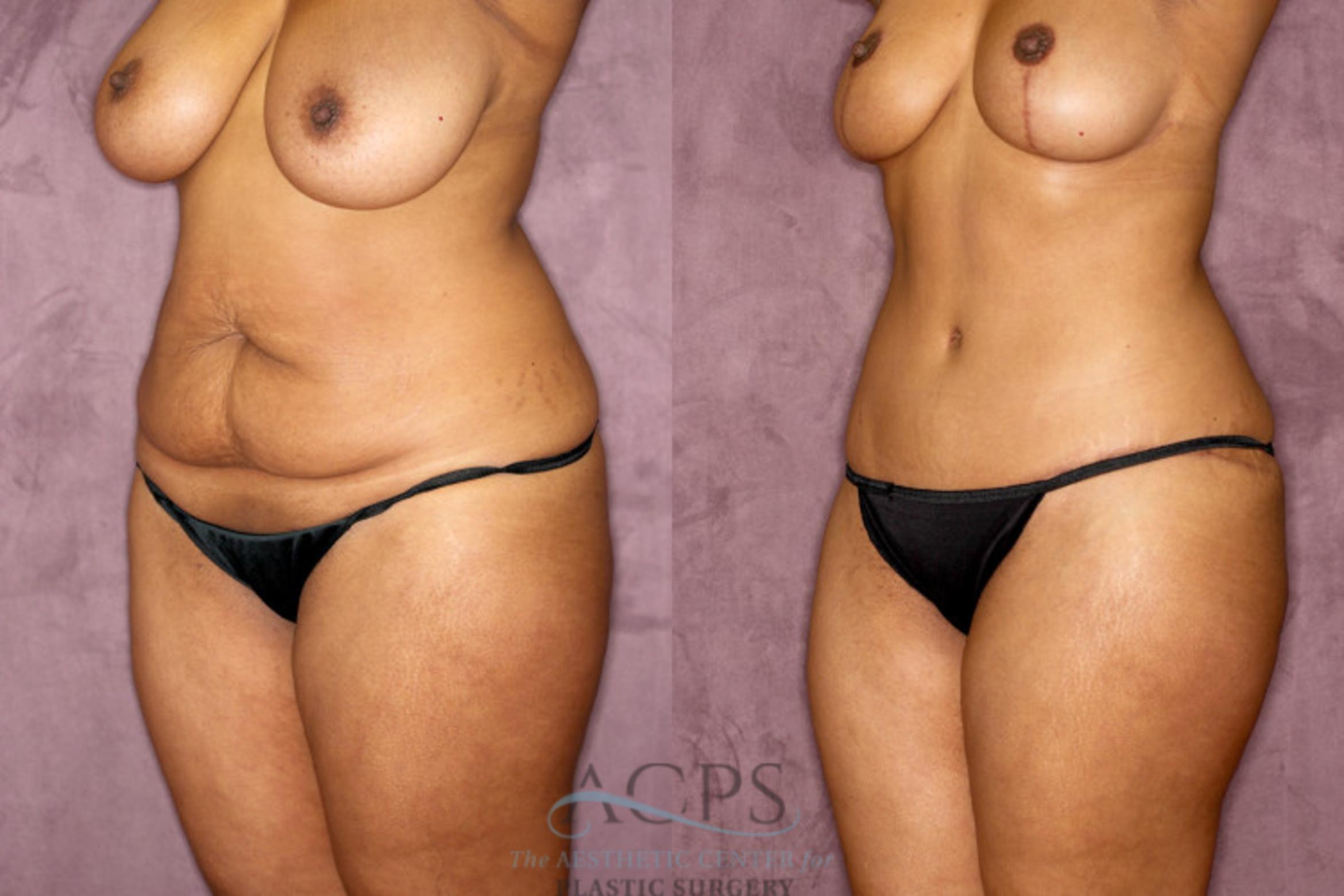 Before & After Tummy Tuck Case 51 Oblique Left View: View in Houston, TX