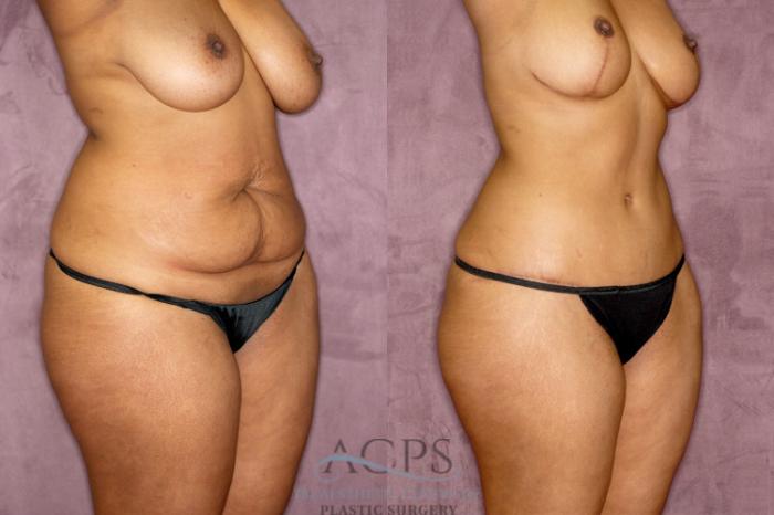Before & After Tummy Tuck Case 51 Oblique Right View: View in Houston, TX