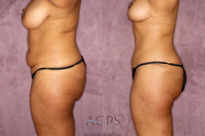 Before & After Tummy Tuck Case 51 Side Left View: View in Houston, TX