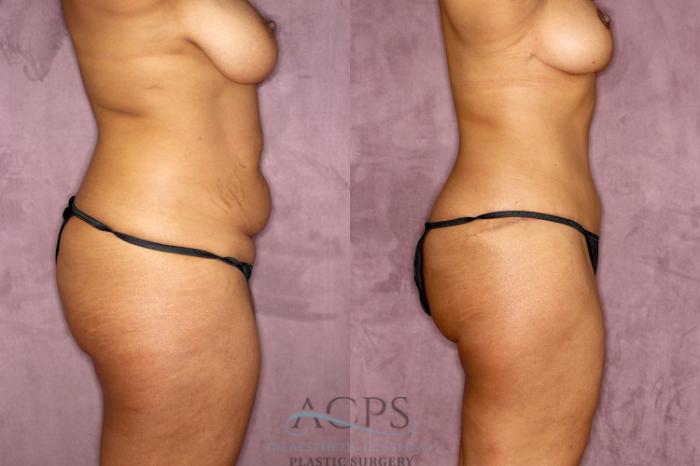 Before & After Tummy Tuck Case 51 Side Right View: View in Houston, TX
