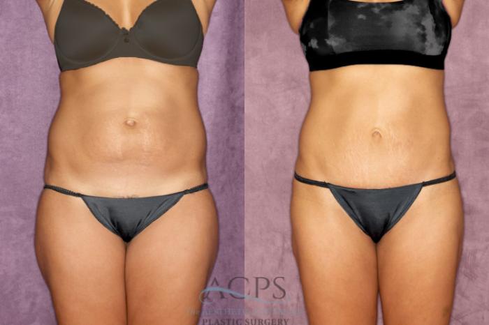 Before & After True Form Tummy Tuck Case 52 Front View: View in Houston, TX