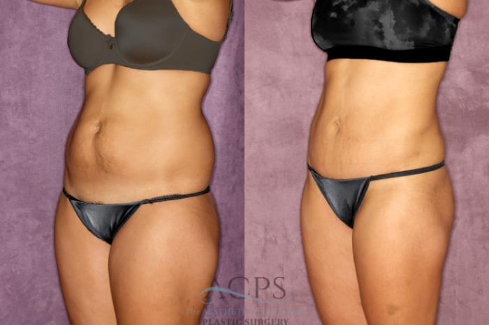 Before & After True Form Tummy Tuck Case 52 Oblique Left View: View in Houston, TX