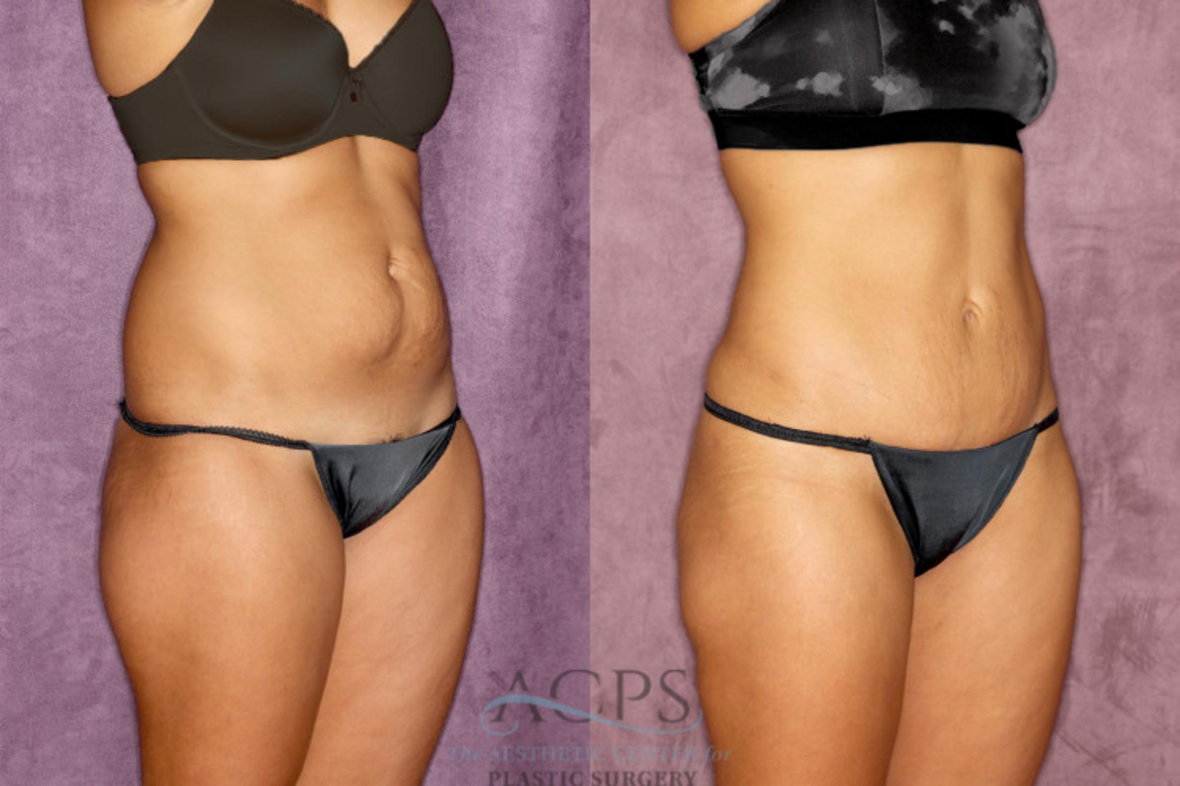 Before & After True Form Tummy Tuck Case 52 Oblique Right View: View in Houston, TX