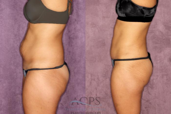 Before & After True Form Tummy Tuck Case 52 Side Left View: View in Houston, TX