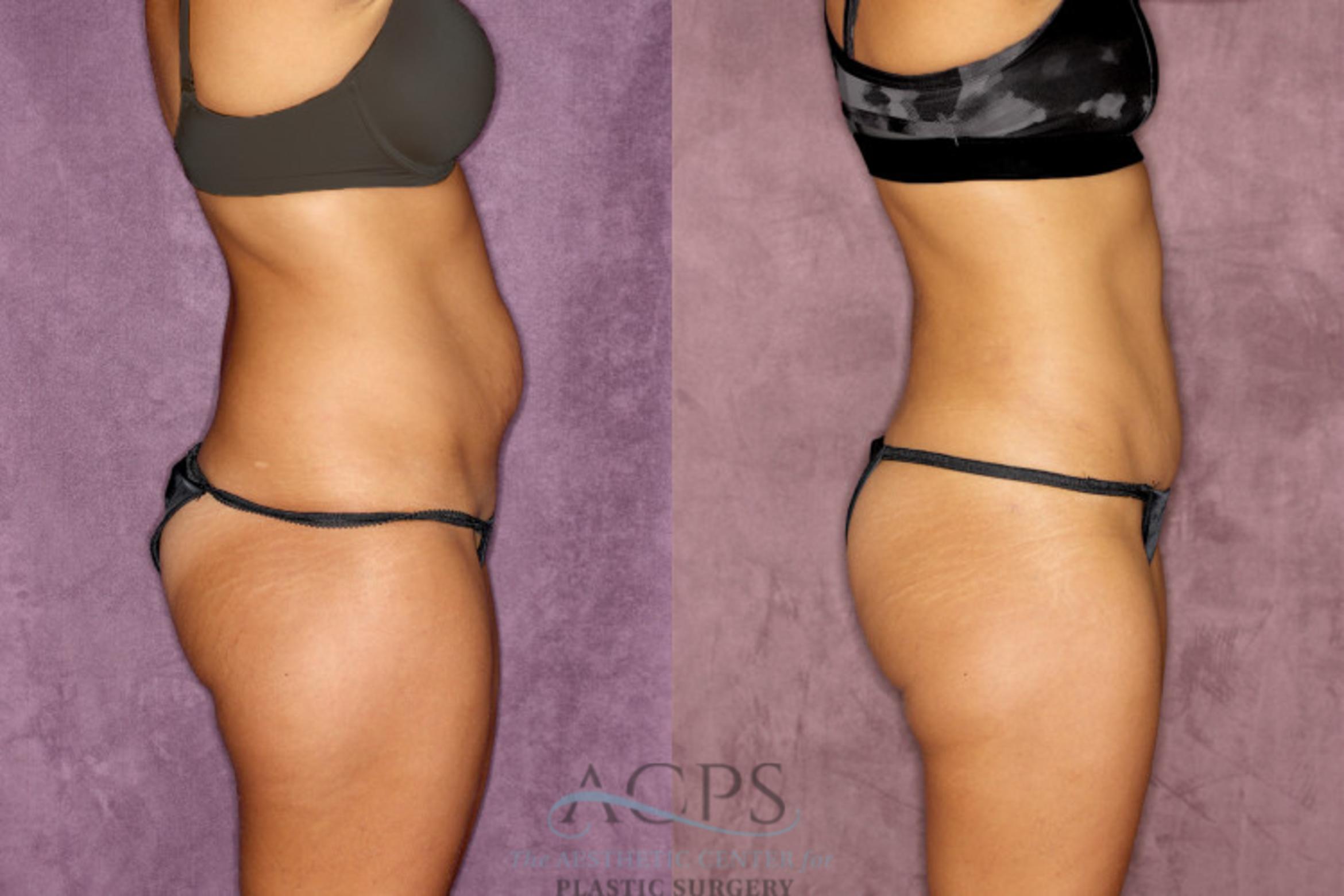 Before & After True Form Tummy Tuck Case 52 Side Right View: View in Houston, TX