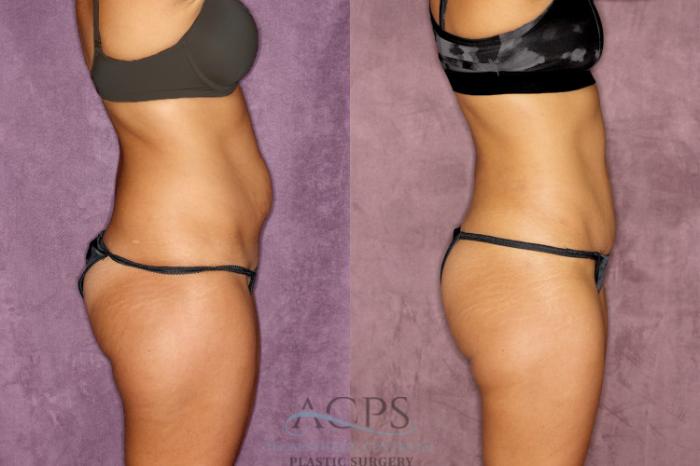 Before & After True Form Tummy Tuck Case 52 Side Right View: View in Houston, TX