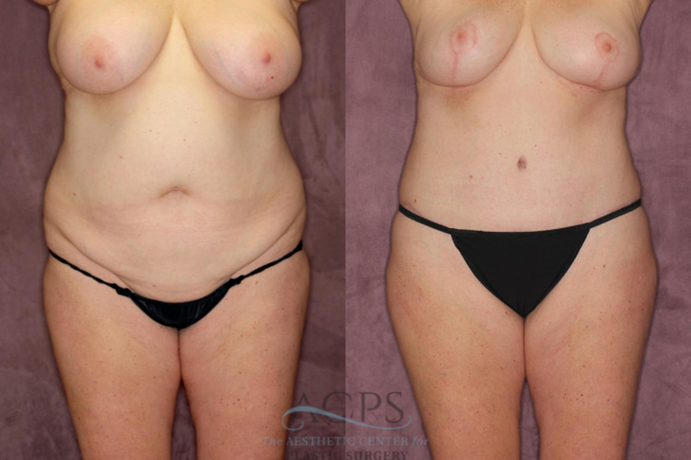 Before & After Tummy Tuck Case 53 Front View: View in Houston, TX