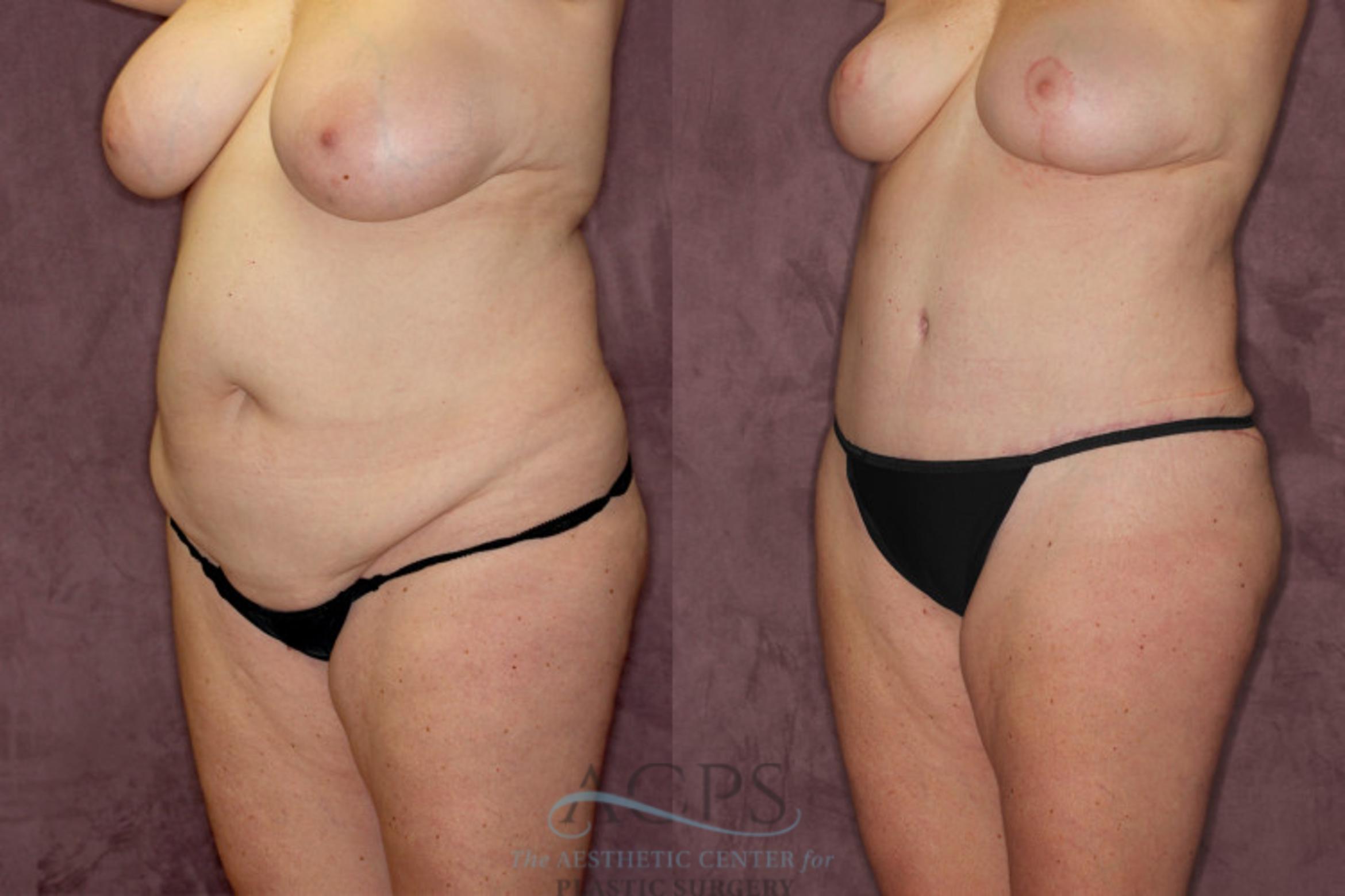 Before & After Tummy Tuck Case 53 Oblique Left View: View in Houston, TX