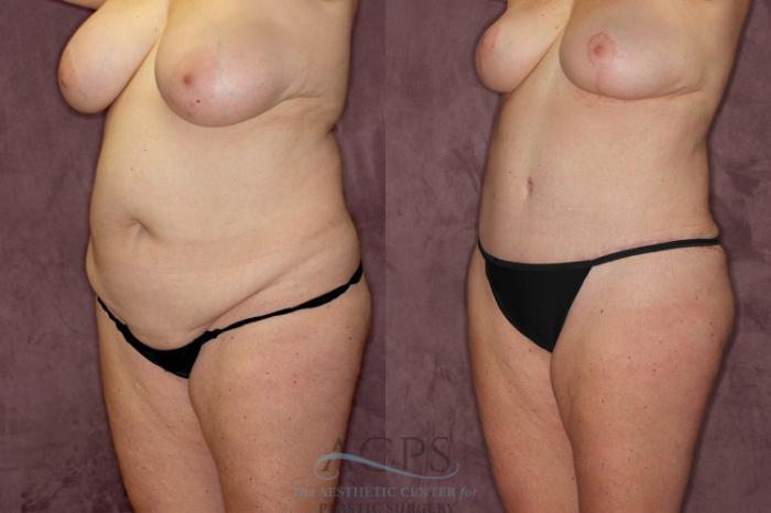 Before & After Tummy Tuck Case 53 Oblique Left View: View in Houston, TX