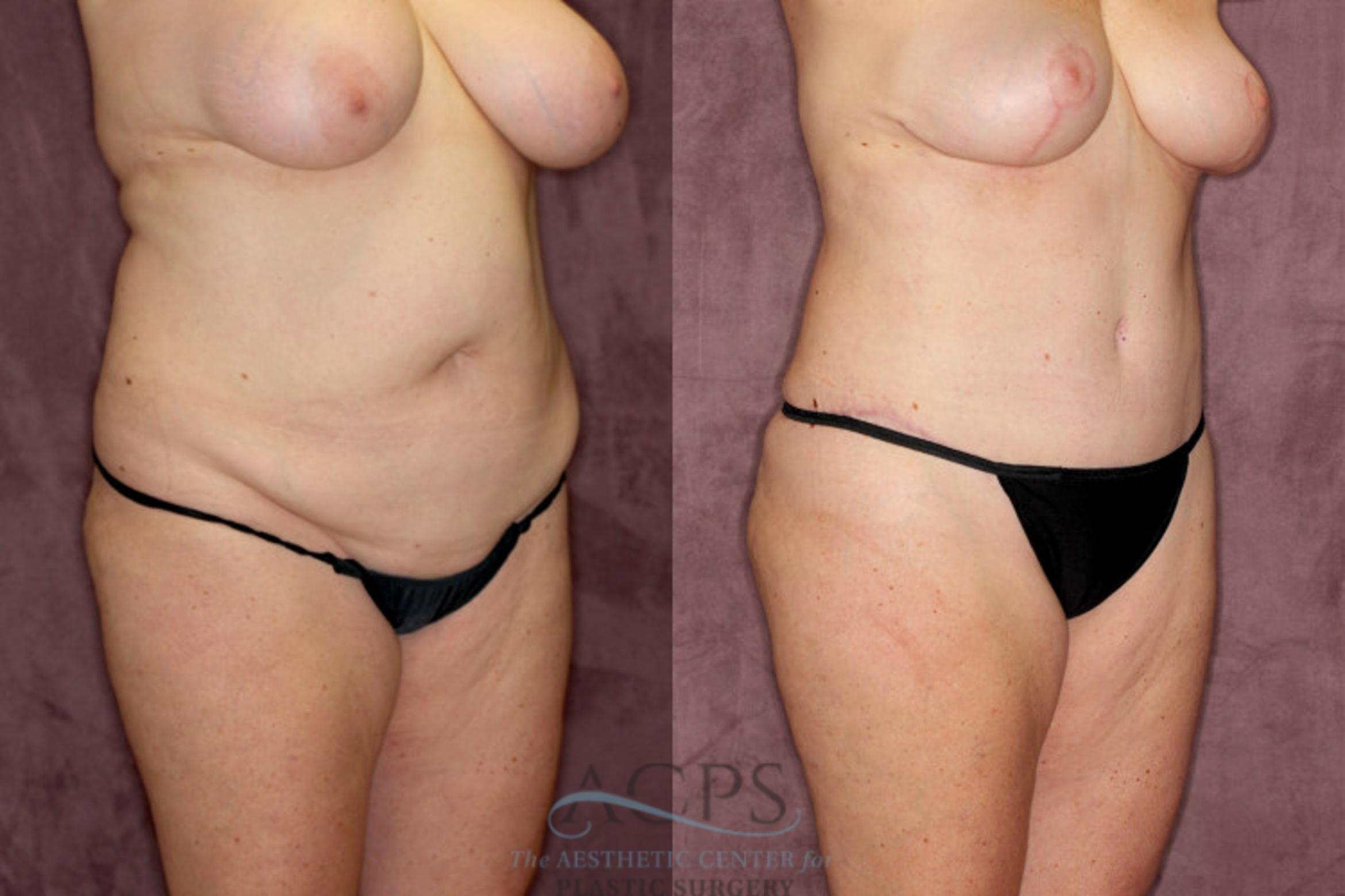 Before & After Tummy Tuck Case 53 Oblique Right View: View in Houston, TX