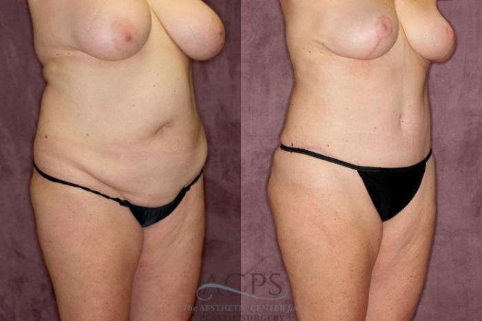 Before & After Tummy Tuck Case 53 Oblique Right View: View in Houston, TX