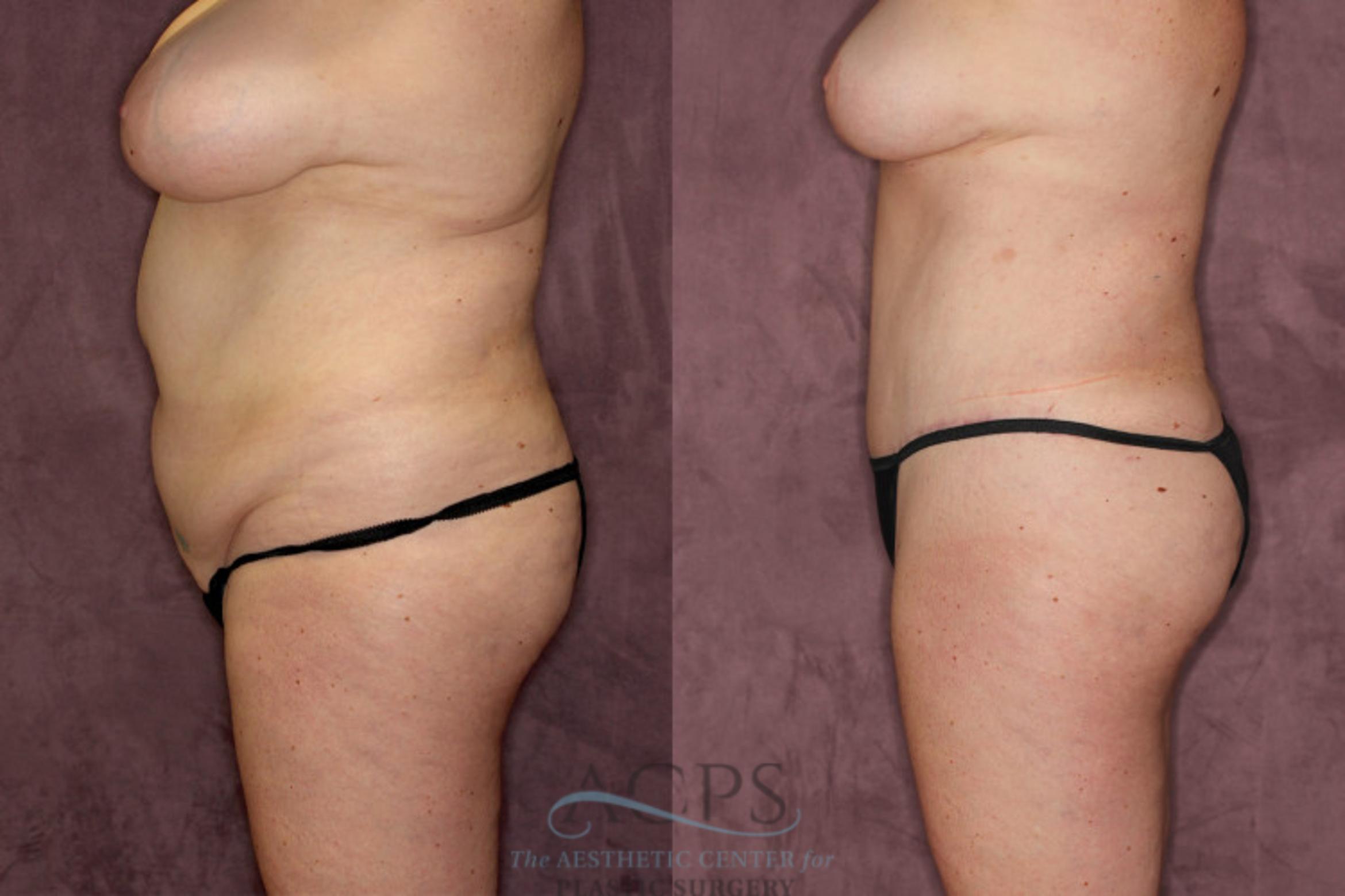 Before & After Tummy Tuck Case 53 Side Left View: View in Houston, TX