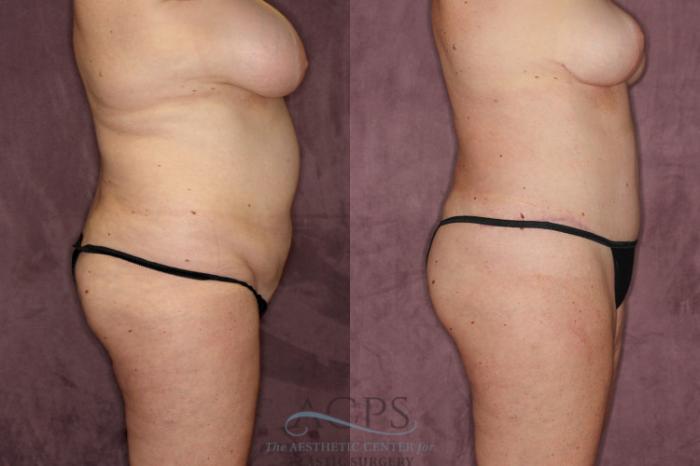 Before & After Tummy Tuck Case 53 Side Right View: View in Houston, TX
