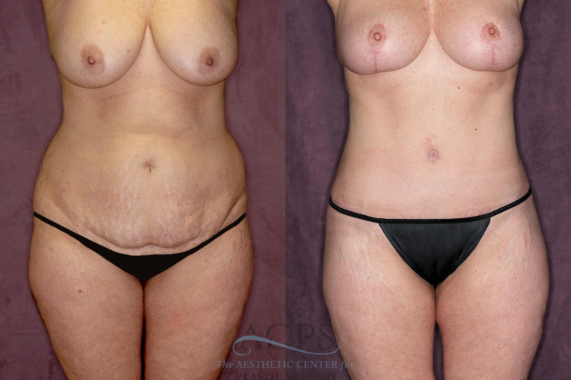 Before & After Tummy Tuck Case 55 Front View: View in Houston, TX