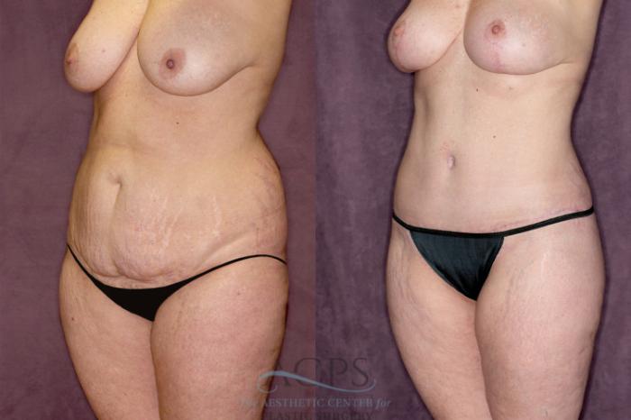 Before & After Tummy Tuck Case 55 Oblique Left View: View in Houston, TX