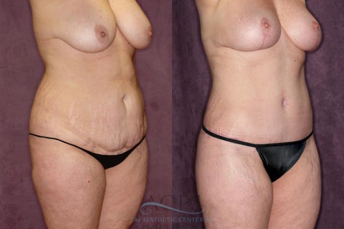 Before & After Tummy Tuck Case 55 Oblique Right View: View in Houston, TX