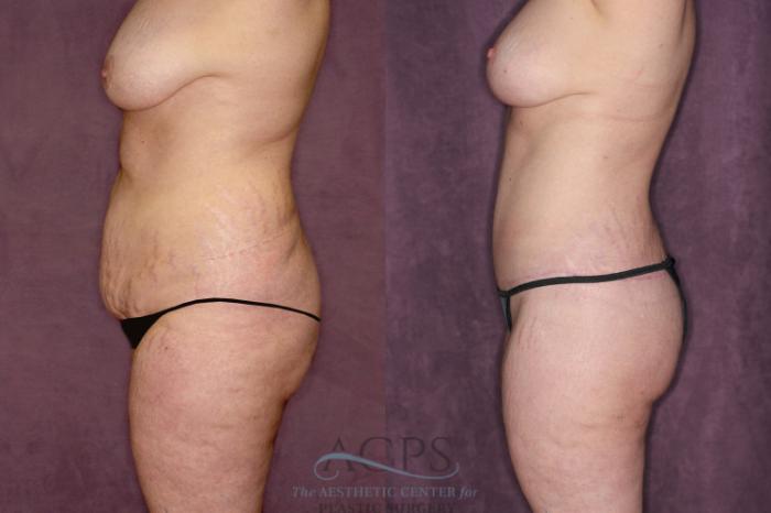 Before & After Tummy Tuck Case 55 Side Left View: View in Houston, TX