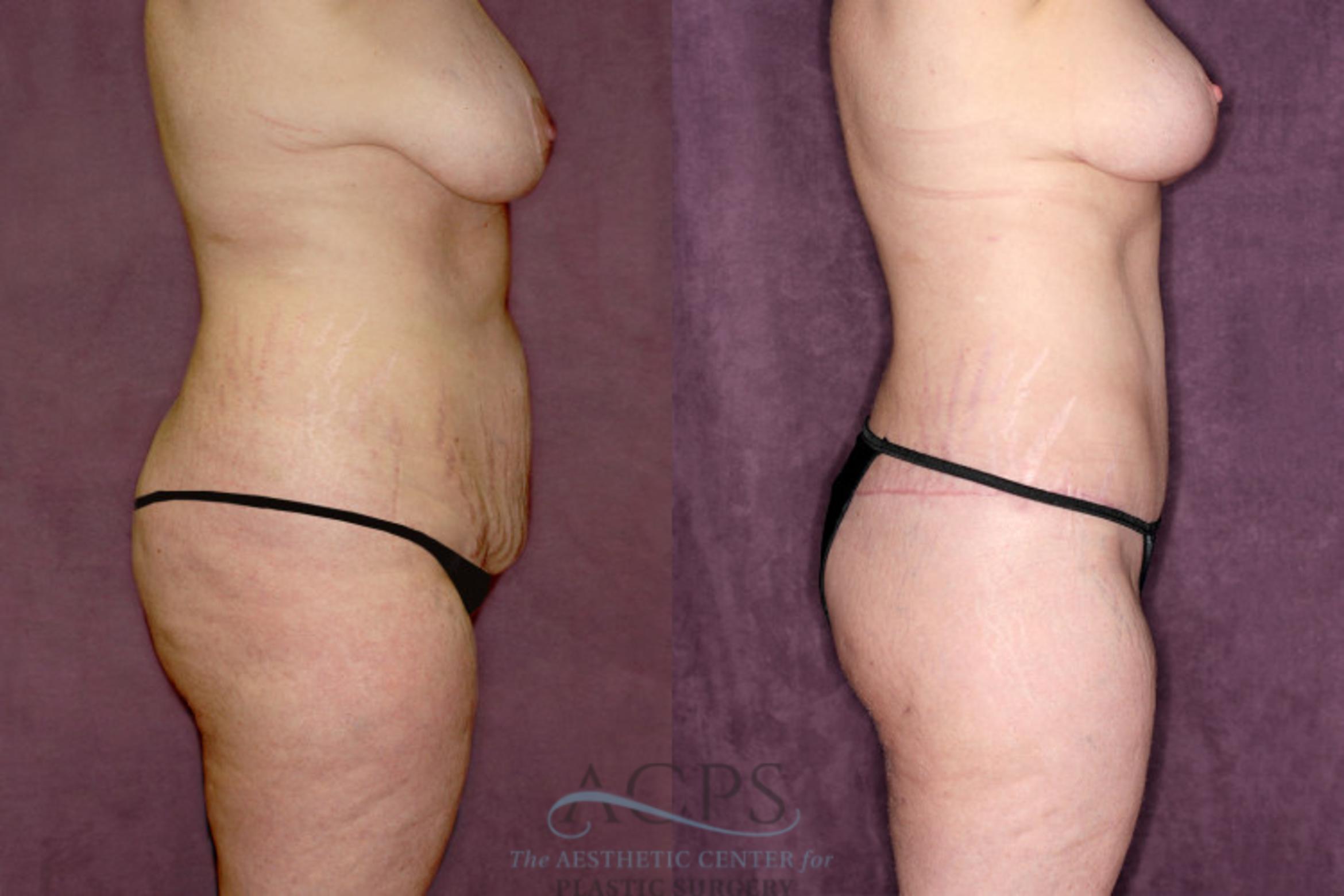 Before & After Tummy Tuck Case 55 Side Right View: View in Houston, TX