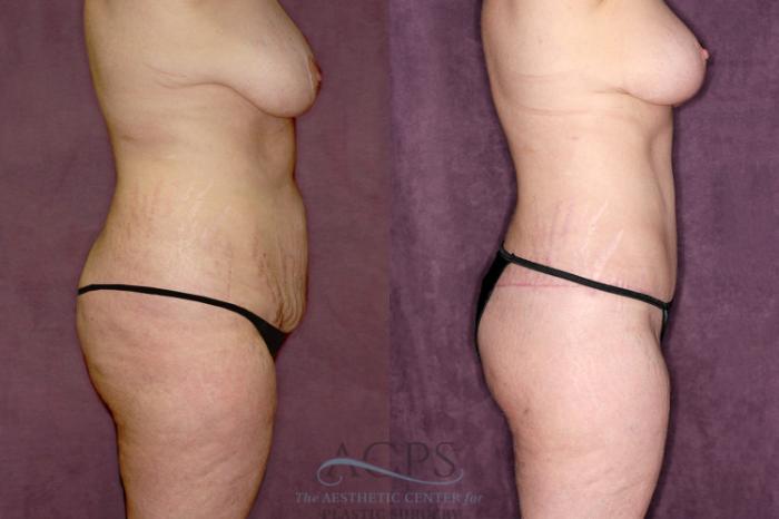 Before & After Tummy Tuck Case 55 Side Right View: View in Houston, TX