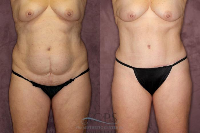 Before & After Liposuction Case 56 Front View: View in Houston, TX