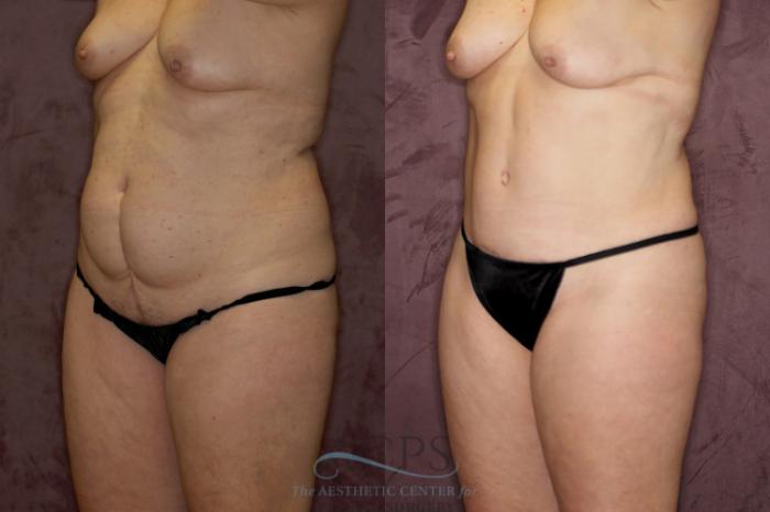 Before & After Liposuction Case 56 Oblique Left View: View in Houston, TX