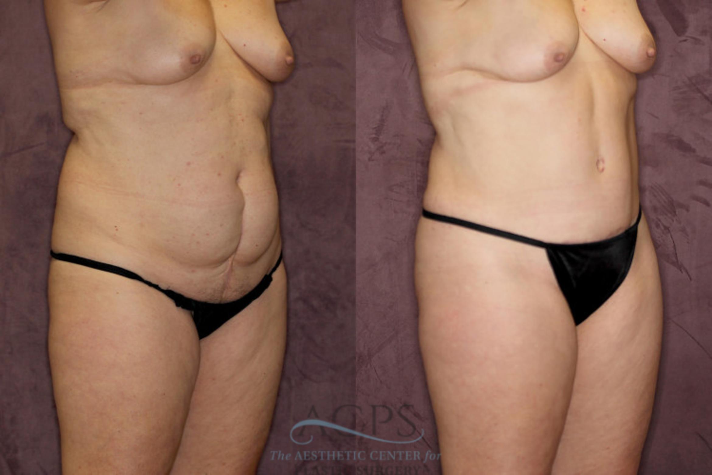 Before & After Liposuction Case 56 Oblique Right View: View in Houston, TX