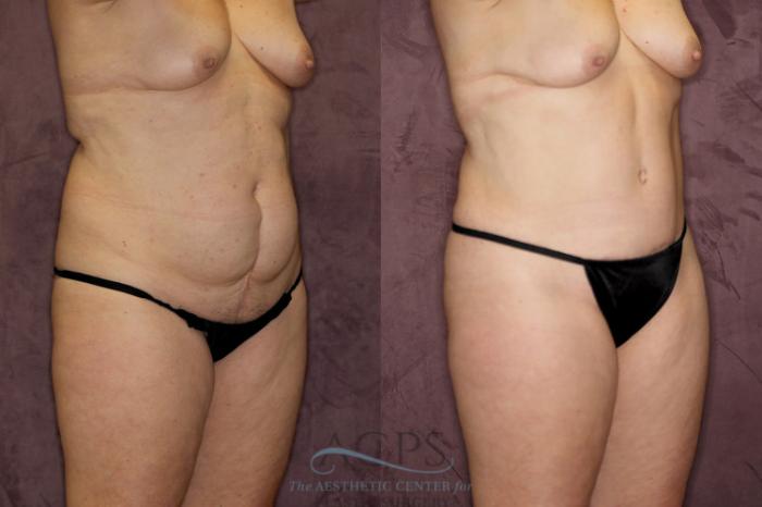 Before & After Liposuction Case 56 Oblique Right View: View in Houston, TX